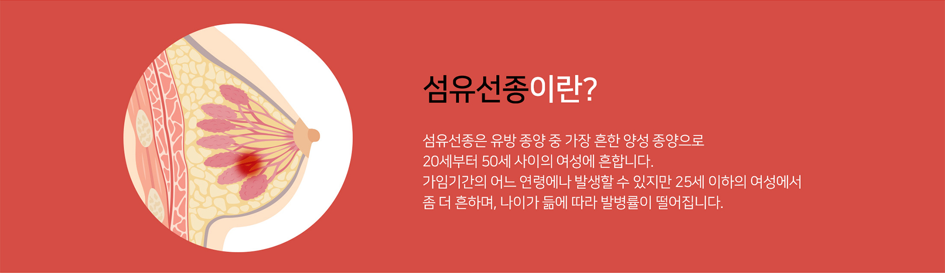 섬유선종이란?